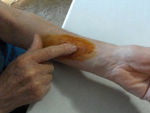application of Lugol's iodine to skin